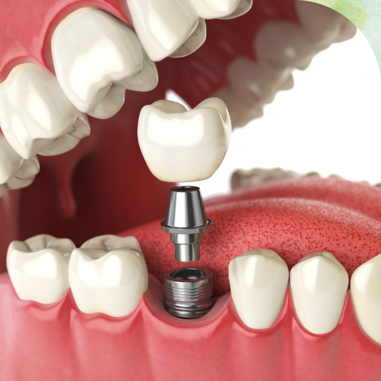 Single Tooth Implant in mira road east
