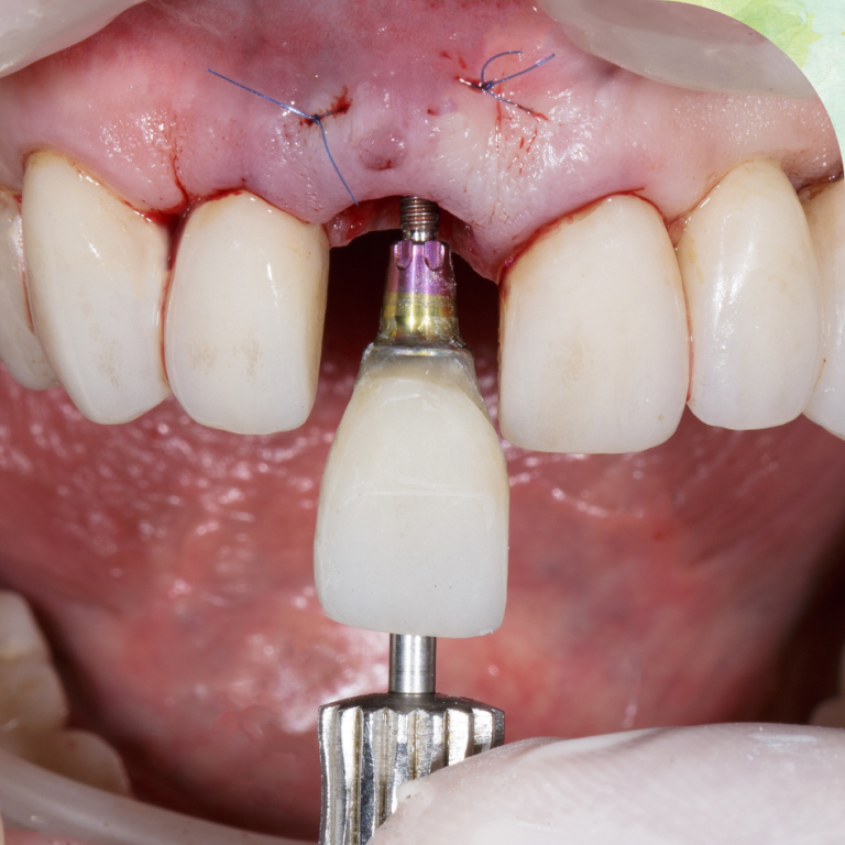 Single Tooth Implant in mira road east