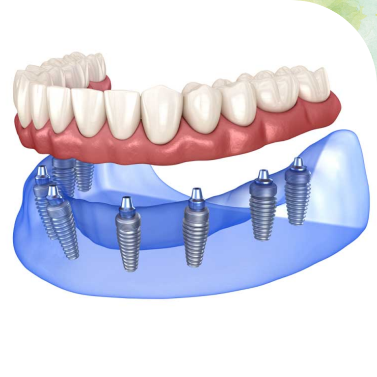 Full Arch Dental Implant Reconstruction