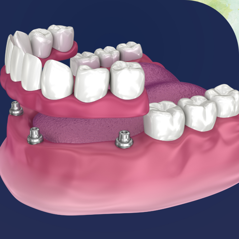 Implant-Supported Denture